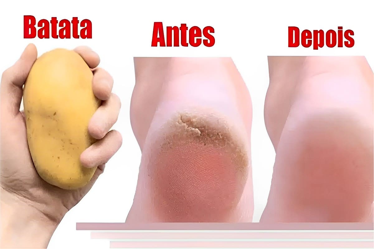 Como deixar seus pés lisos e sem rachaduras com um ingredientes simples que você tem em casa