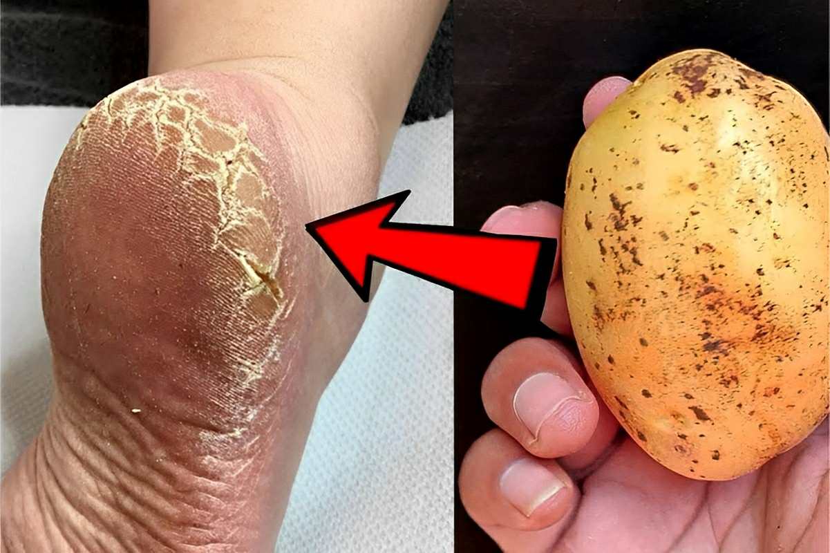 Como acabei com as rachaduras dos meus pés usando uma batata