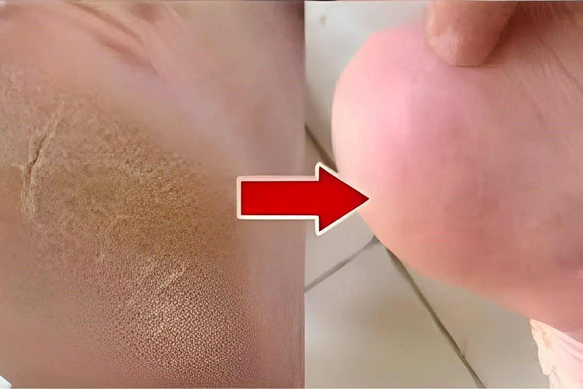 Dica para acabar com rachaduras dos pés na primeira noite os rachados do pé já melhoram