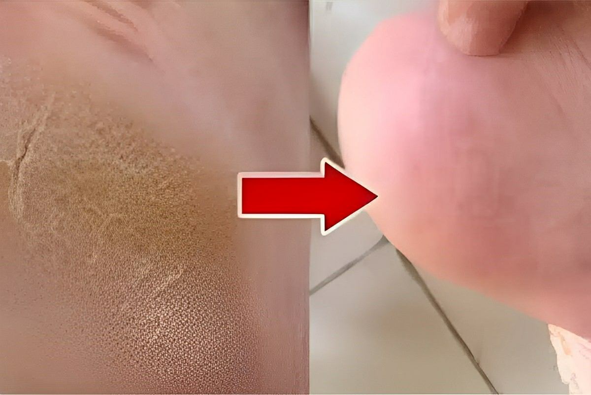 Dica para acabar com as rachaduras nos pés que deixa os pés lisinhos desde a primeira aplicação