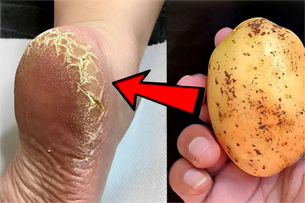 Como acabei com as rachaduras do pé usando um ingrediente natural que eu tinha em casa