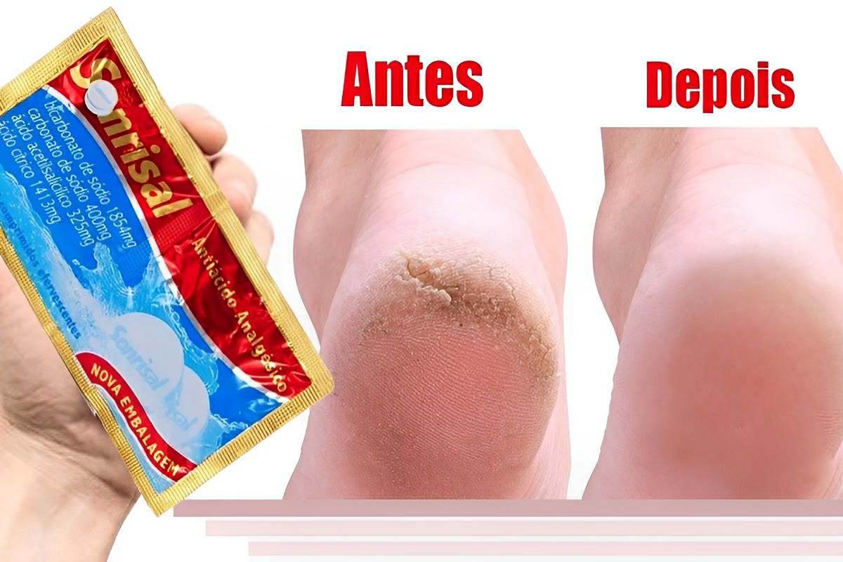 Como hidratar pés rachados usando 3 ingredientes que você tem no armário