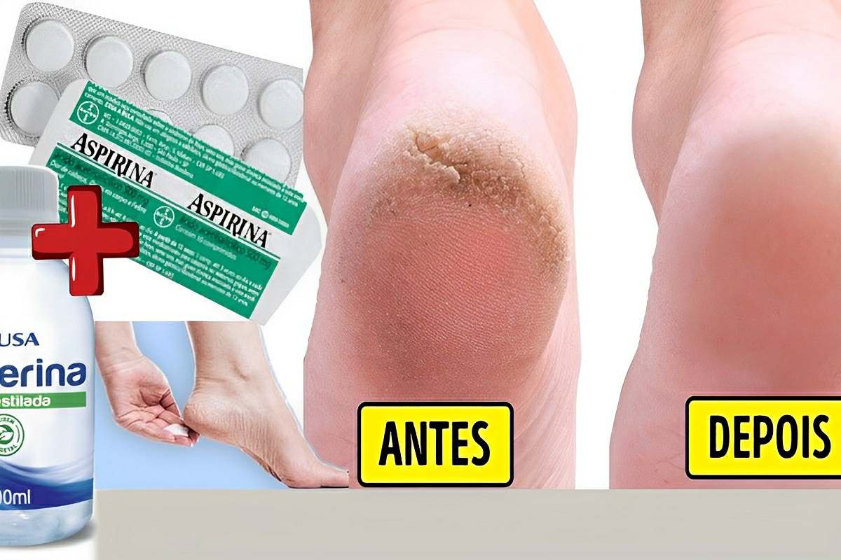 Fiz esse hidratante caseiro para pés rachados e o resultado foi surpreendente