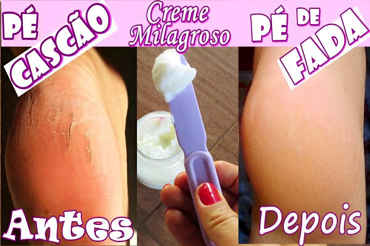 Creme caseiro para pés rachados que vai deixar os seus pés muito macios e hidratados