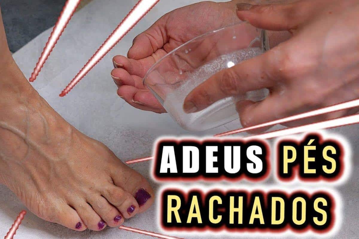 Como acabar com as rachaduras nos pés e tirar todo aquele ressecamento que te incomoda