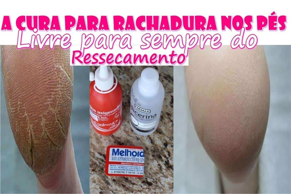 Acabe com o ressecamento e rachaduras com essa dica para pés rachados infalível