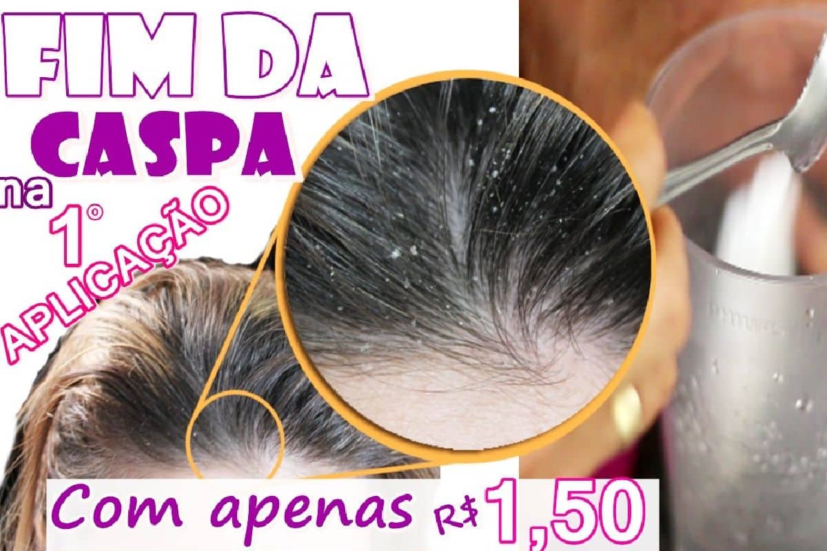 Como acabar com a caspa sem precisar comprar shampoo caro