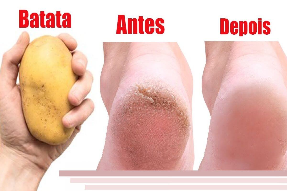 Você não vai acreditar nessa dica de como deixar seus pés lisos e sem rachaduras nos calcanhares