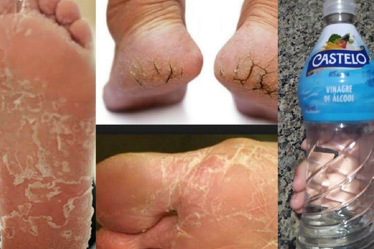 Seus problemas com pés rachados está com os dias contados com essa dica