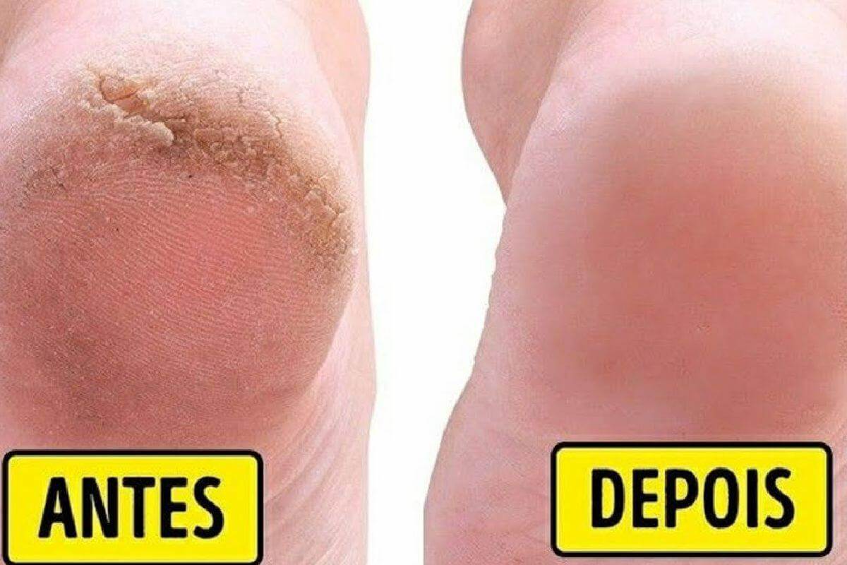 Dica para pés rachados e ressecados ficarem lisinhos parecendo pezinho de bebê
