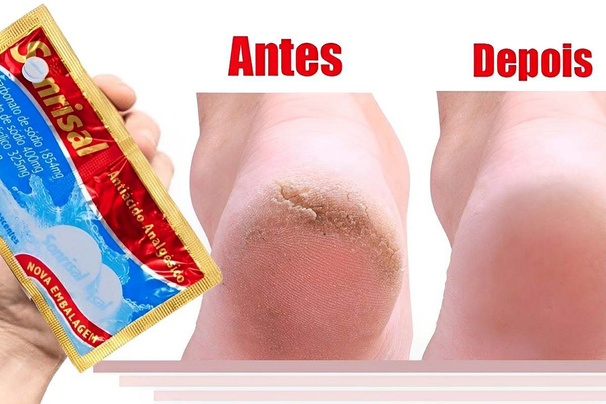 Como hidratar pés rachados sem precisar comprar produto em loja de cosméticos