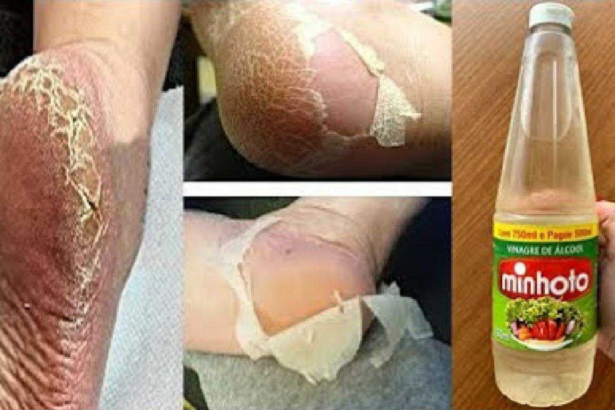 Dica para pés rachados e ressecados para deixar tudo lisinho e sem rachaduras