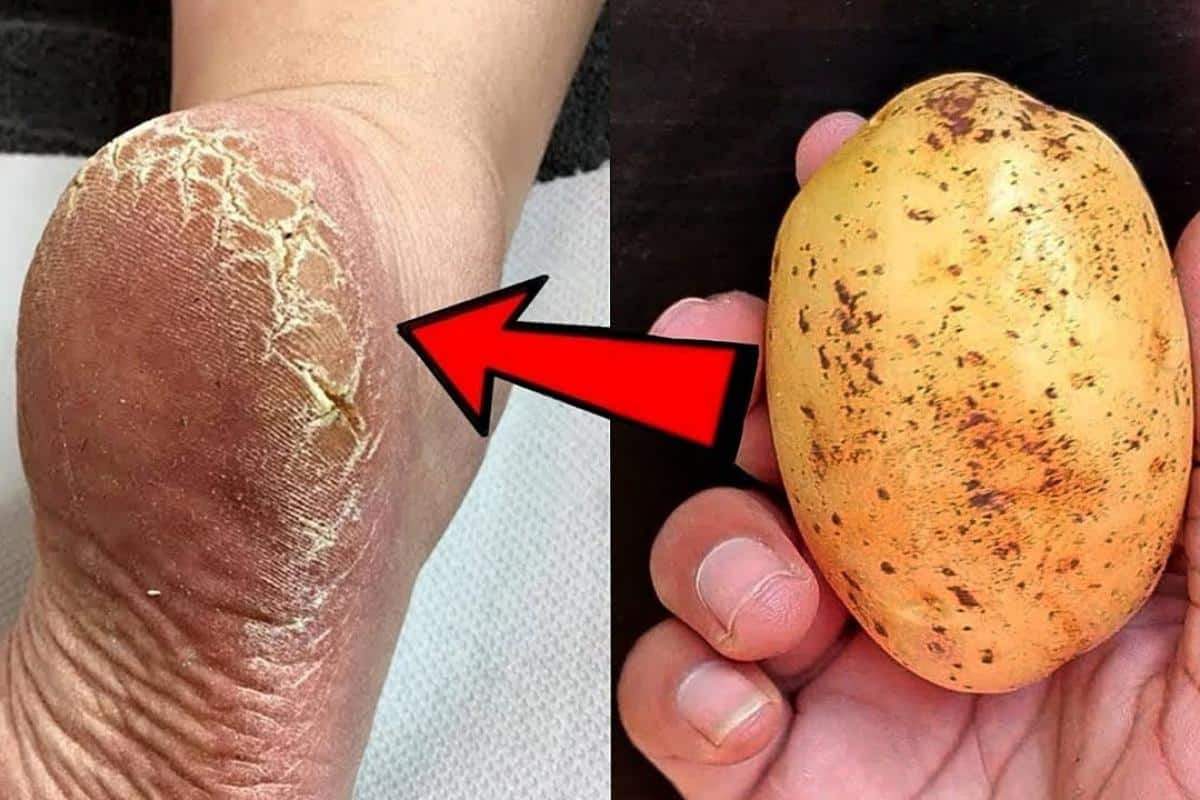 Como acabei com as rachaduras dos meus pés sem precisar ir na podóloga