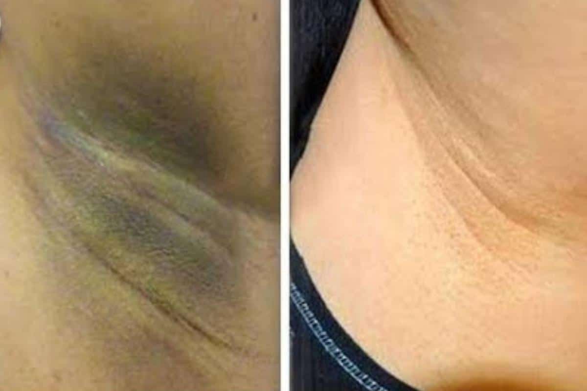 Como clarear as axilas com uma receitinha caseira que dá resultado de verdade