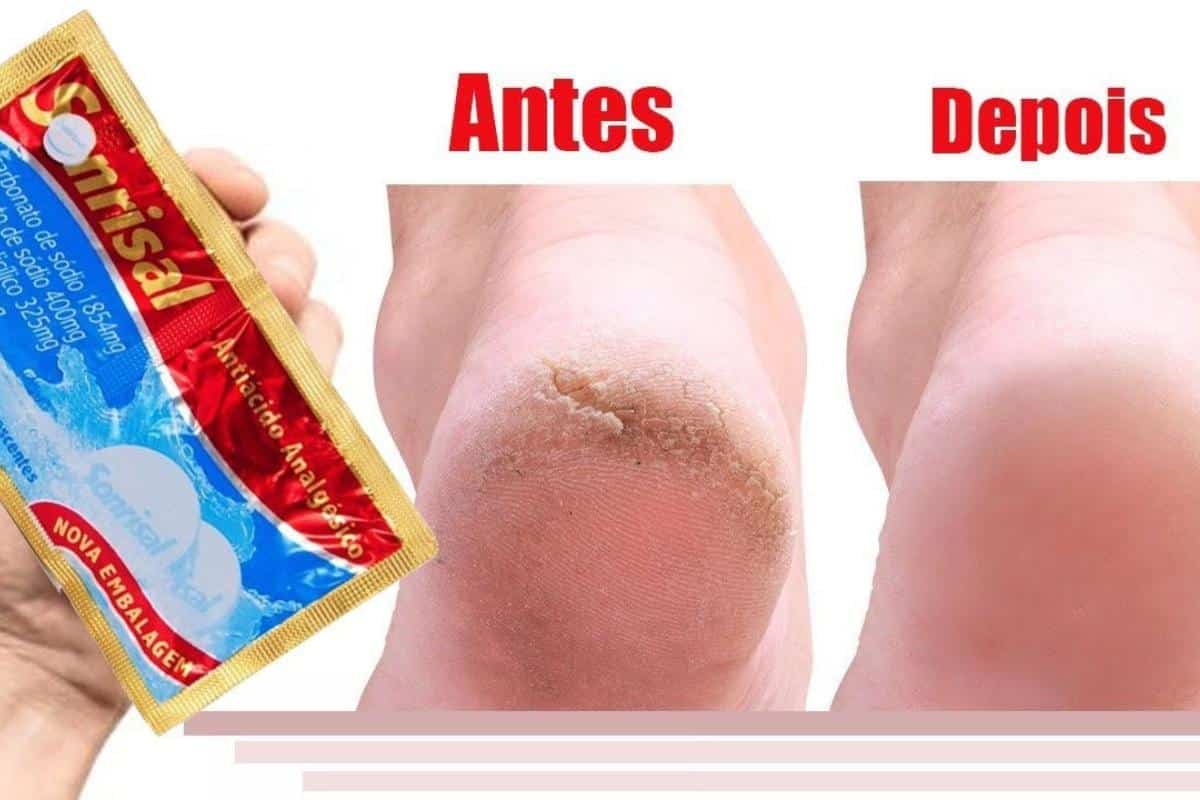 Como hidratar pés rachados e ressecados sem precisar ir na podóloga