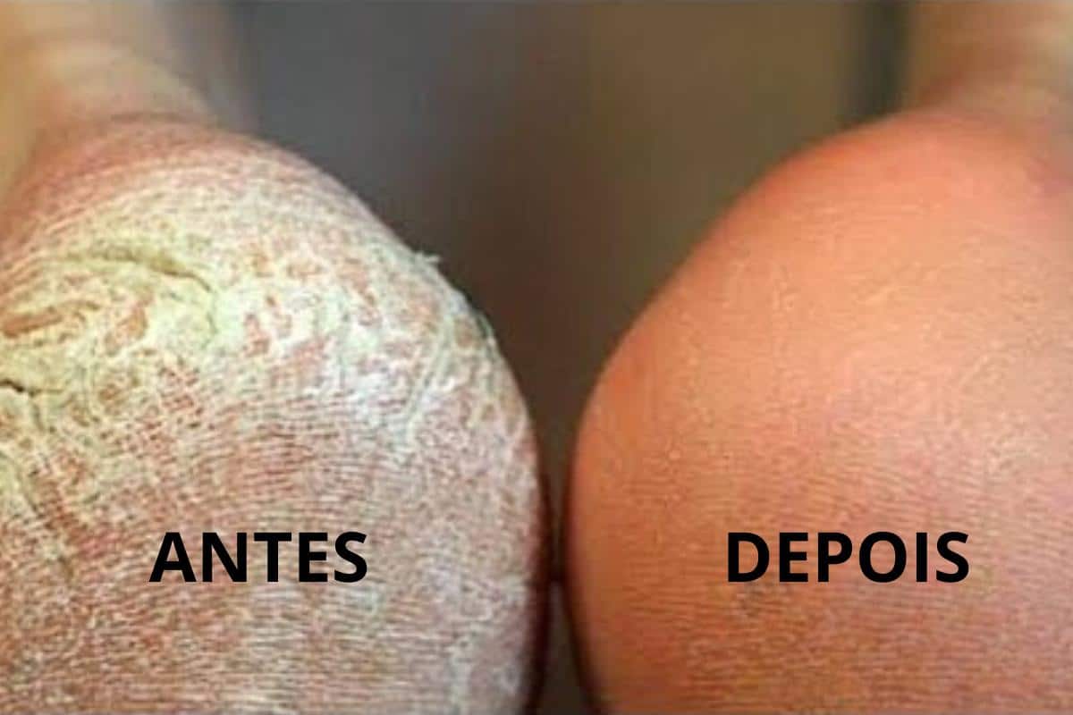 Seus problemas acabaram: ótima dica para pés ressecados e com rachaduras, testada e aprovada