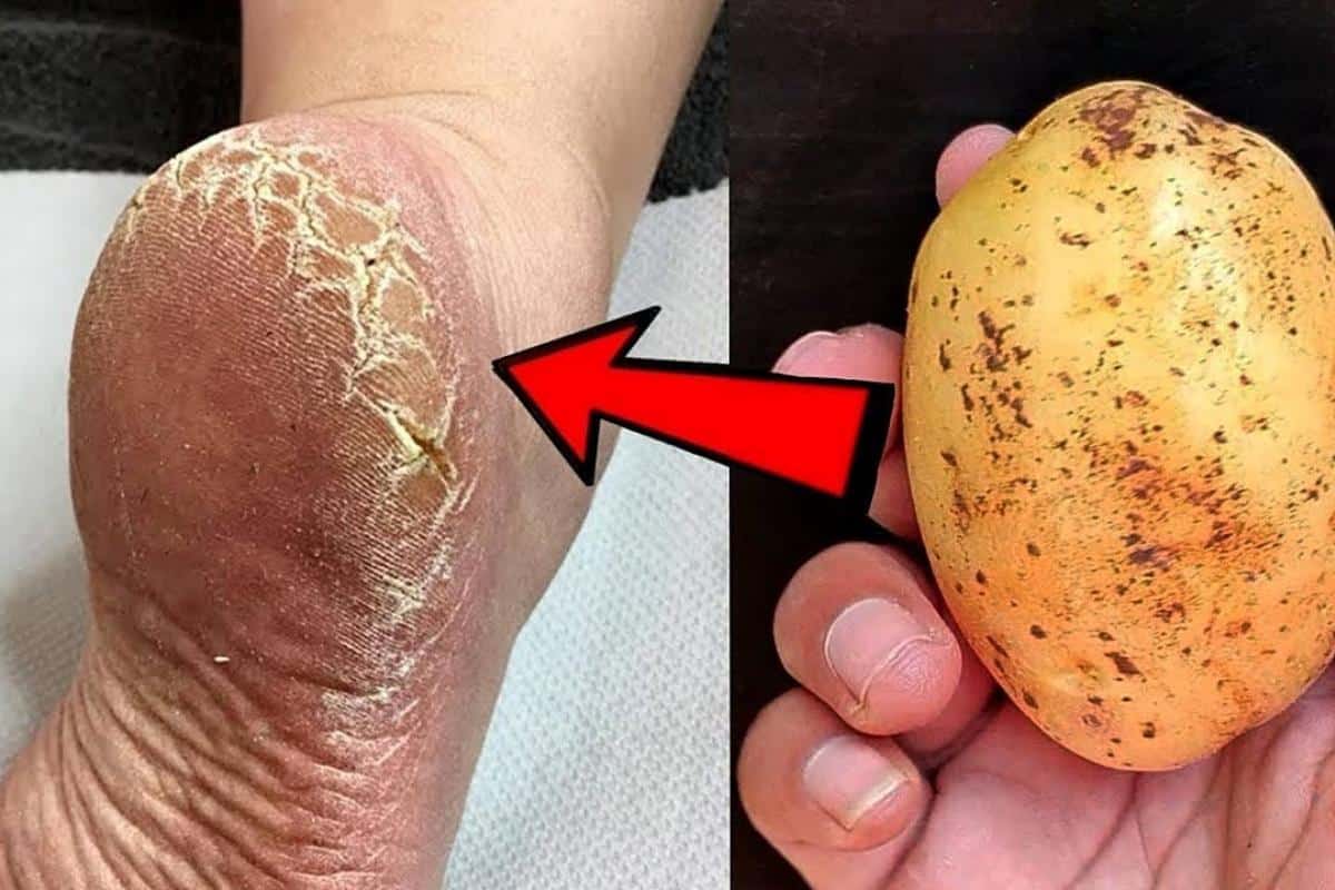 Como acabar com as rachaduras dos pés com uma dica de podóloga famosa na internet