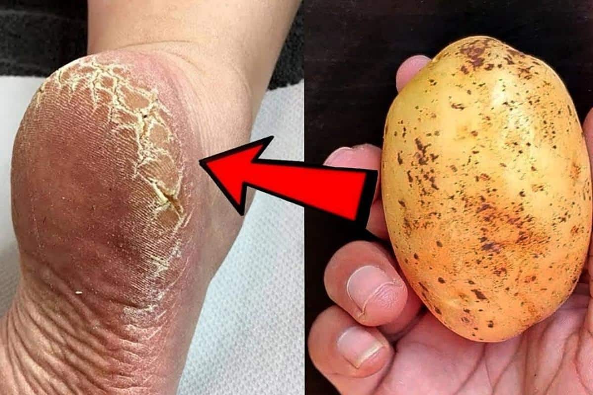 Como acabar com as rachaduras dos pés: não precisa gastar na loja de cosméticos