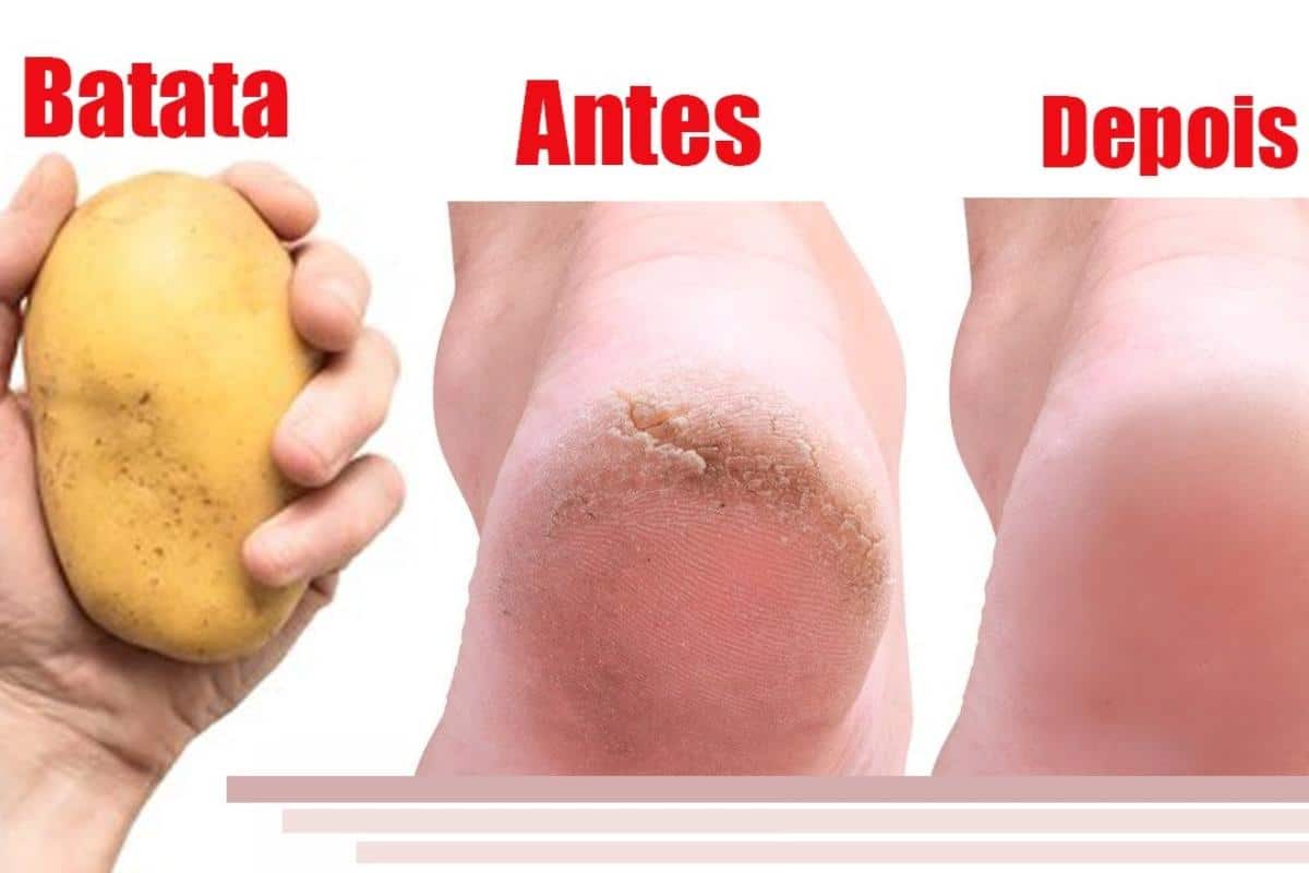 Como deixar os pés lisos: acabe com as rachaduras sem usar cosméticos