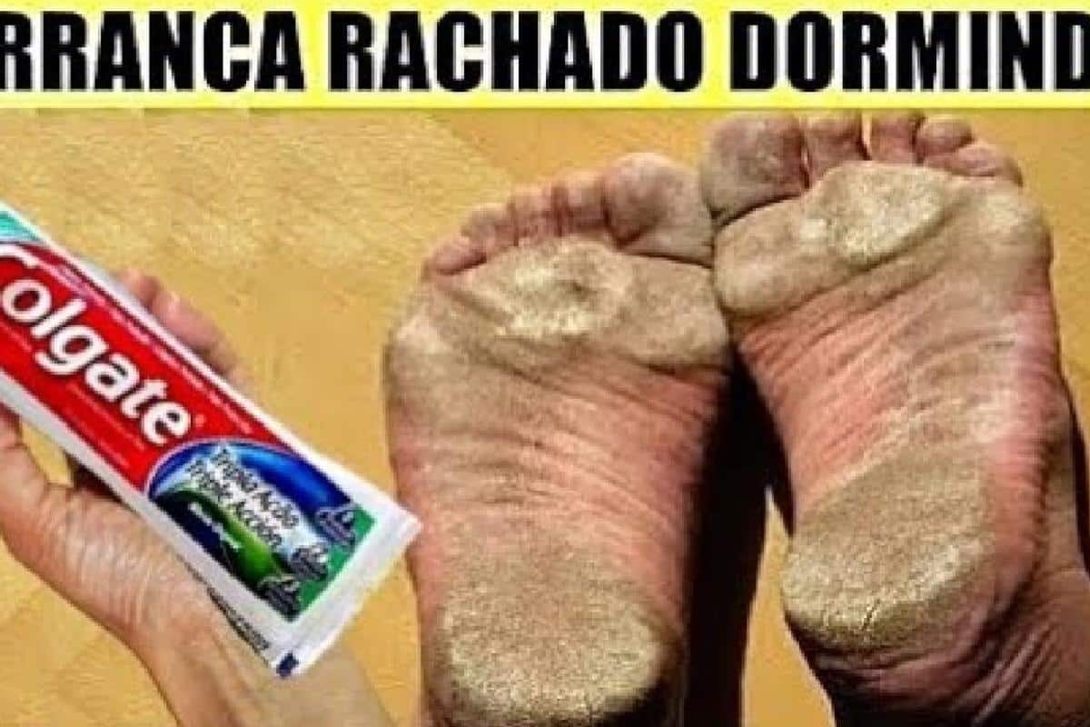 Como tirar rachadura dos pés: veja como ter pés lisinhos e sem calos