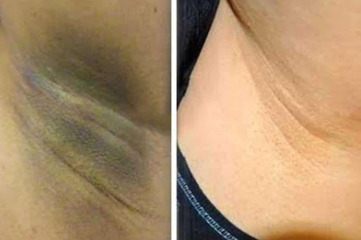 Como clarear as axilas com uma receita caseira que você vai amar o resultado