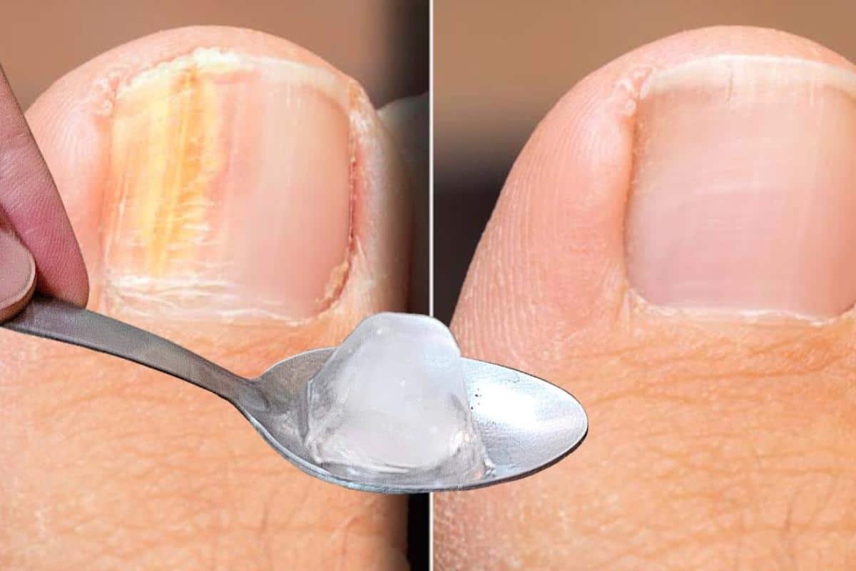 Como remover micose da unha sem precisar gastar dinheiro com cosmético caro