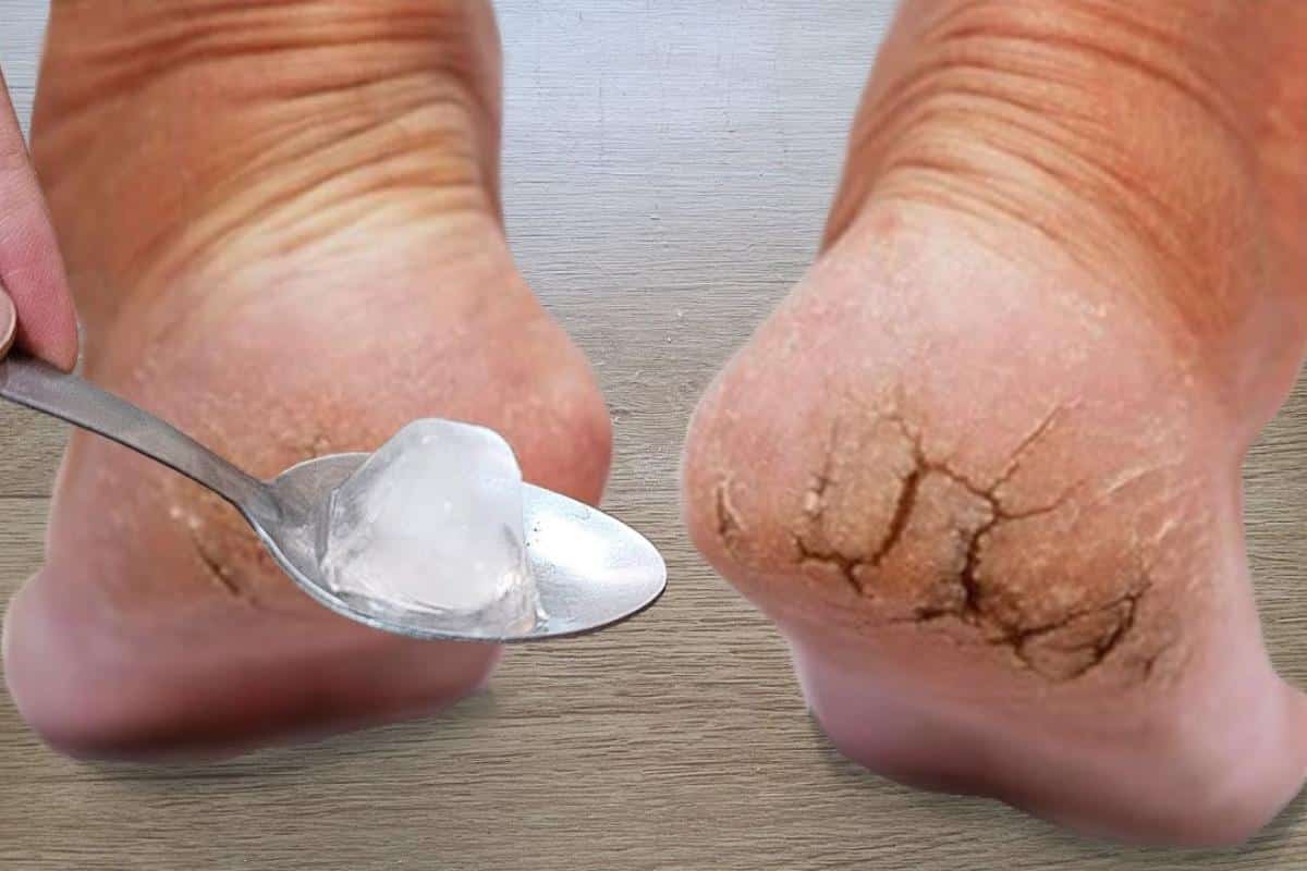 Como tirar rachaduras dos pés: segredo de podóloga profissional para alisar os pés